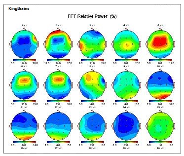 A QEEG brain map showing FFT relative power (%) across the scalp at 1–20 Hz.